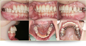 入れ歯の症例2 術前
