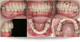 入れ歯の症例2 術後