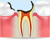 重度の虫歯を「根」から治療する