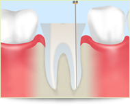 重度の虫歯を「根」から治療する