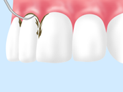 治療法2 軽度歯周病